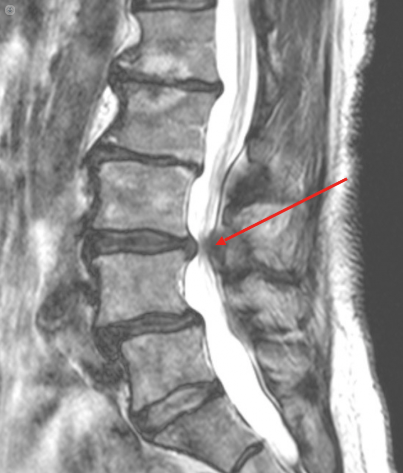 mri-lumbar-spine-scan-sagittal-view-lumbosacral-spine-has-straightening